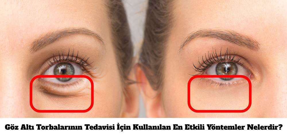 Göz altı şişlikleri için size güzel bir tarifimiz var