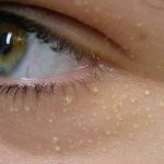 YÜZDEKİ YAĞ BEZELERİNDEN NASIL KURTULURSUNUZ