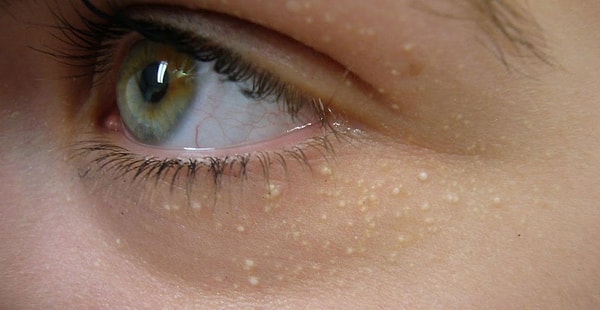 YÜZDEKİ YAĞ BEZELERİNDEN NASIL KURTULURSUNUZ