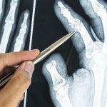 Romatizma için çok etkili doğal yağ tarifi