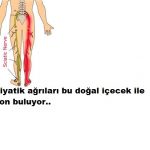 Siyatik ağrıları için doğal çözüm