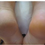 Topuk çatlaklarını yok eden en etkili yöntem