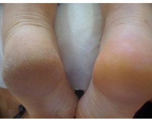 Read more about the article Topuk çatlaklarını yok eden en etkili yöntem