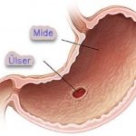 Mide ülseri için doğal içecek tarifi