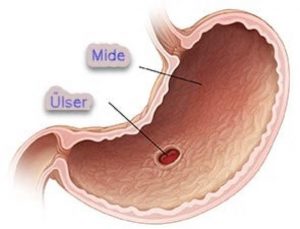 Read more about the article Mide ülseri için doğal içecek tarifi