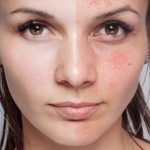 Cilt lekelerini yok eden bu karışım