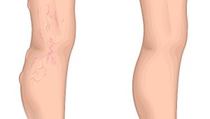 Read more about the article Varis için bu karışımı kullanın