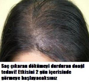 Read more about the article Saç çıkaran çok etkili kür kelliğe son