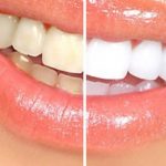 Dişleri beyazlatacak doğal tarif