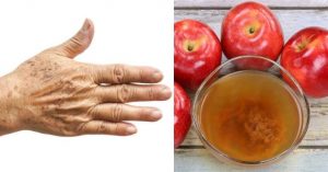 Read more about the article Kahverengi lekeleri geçiren tek doğal kür