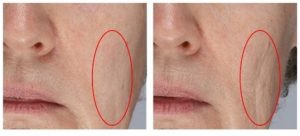 Read more about the article Kırışıklık giderici  en etkili tarif