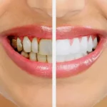 Diş tartarlarınızı bu yöntemle yok edebilirsiniz