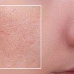 Yüz yağlanması nasıl yok edilir